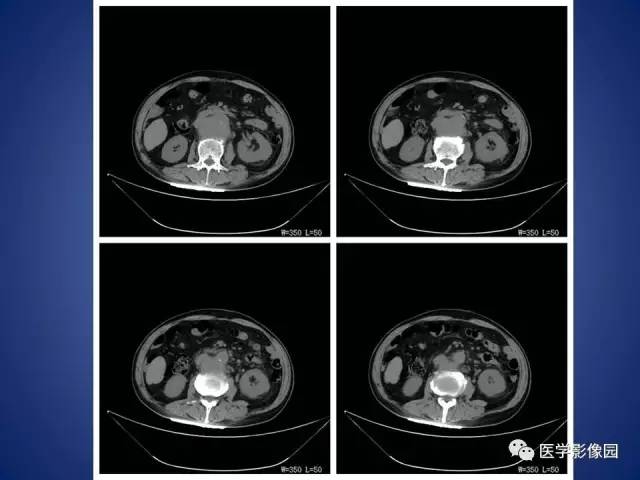 【病例】腹主动脉假性动脉瘤1例CT