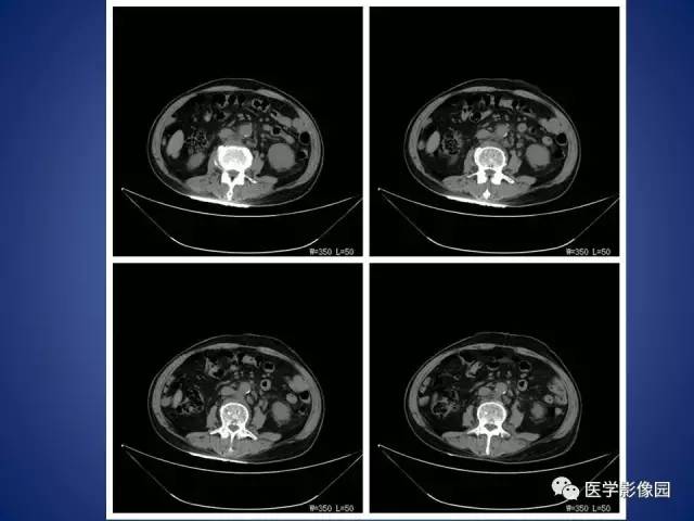 【病例】腹主动脉假性动脉瘤1例CT