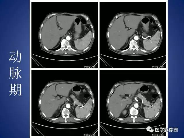 【病例】腹主动脉假性动脉瘤1例CT