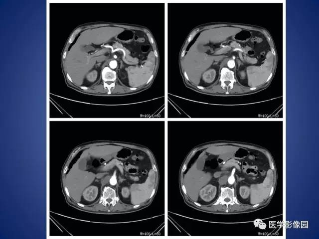【病例】腹主动脉假性动脉瘤1例CT