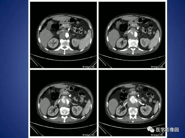 【病例】腹主动脉假性动脉瘤1例CT