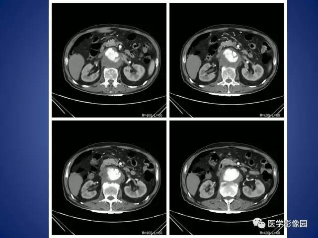 【病例】腹主动脉假性动脉瘤1例CT