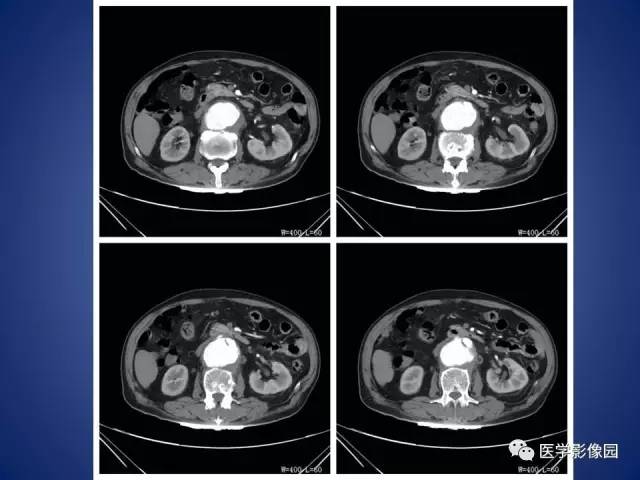 【病例】腹主动脉假性动脉瘤1例CT