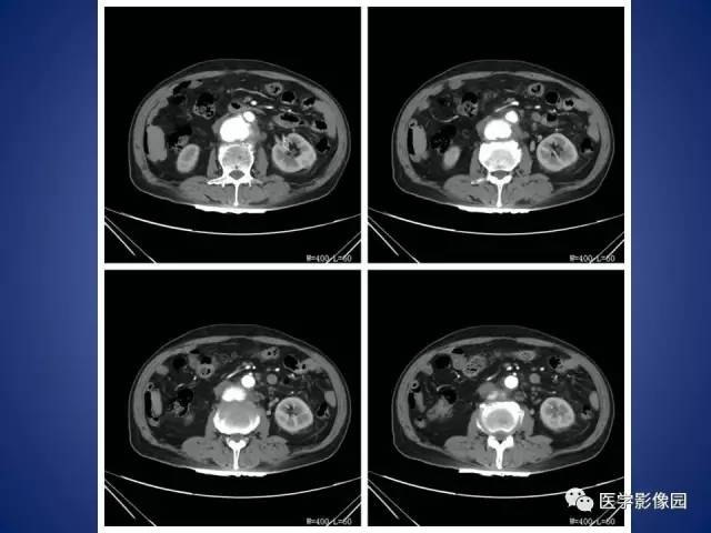 【病例】腹主动脉假性动脉瘤1例CT