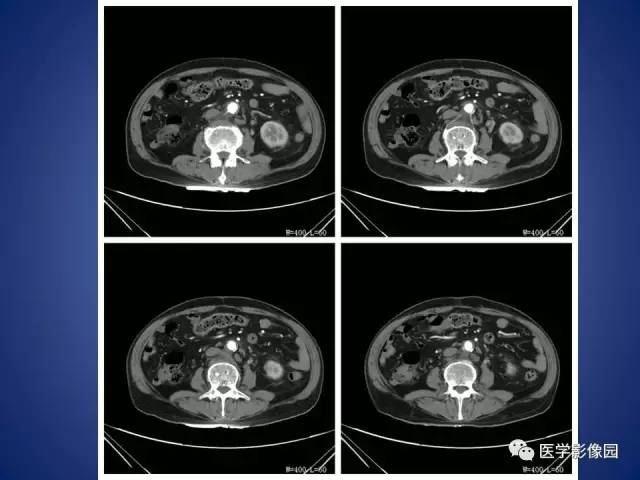 【病例】腹主动脉假性动脉瘤1例CT