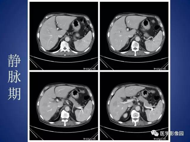 【病例】腹主动脉假性动脉瘤1例CT