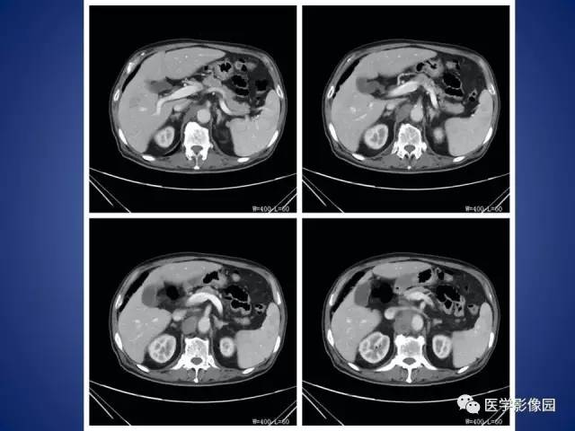 【病例】腹主动脉假性动脉瘤1例CT