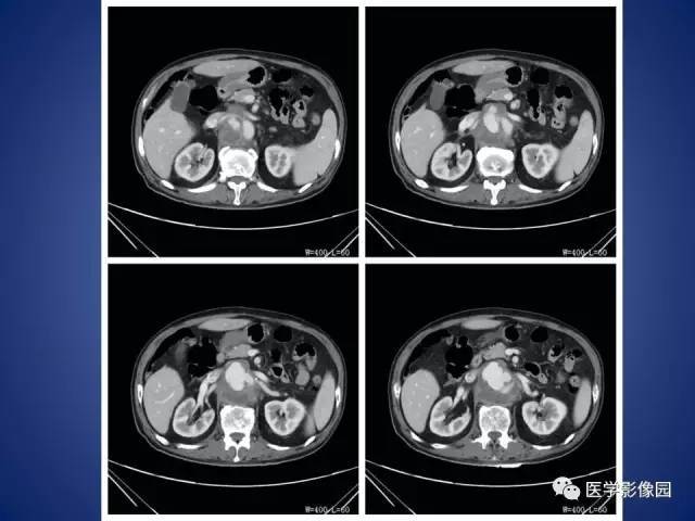 【病例】腹主动脉假性动脉瘤1例CT
