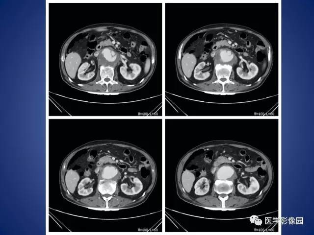 【病例】腹主动脉假性动脉瘤1例CT
