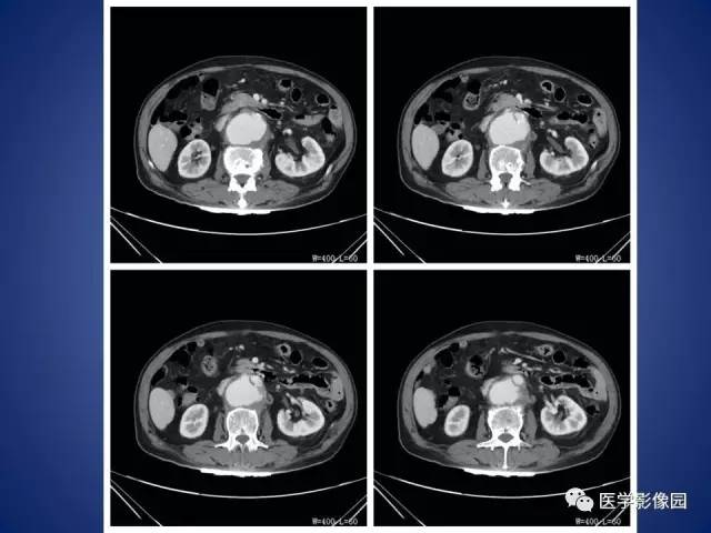 【病例】腹主动脉假性动脉瘤1例CT