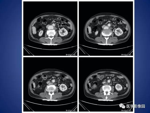 【病例】腹主动脉假性动脉瘤1例CT