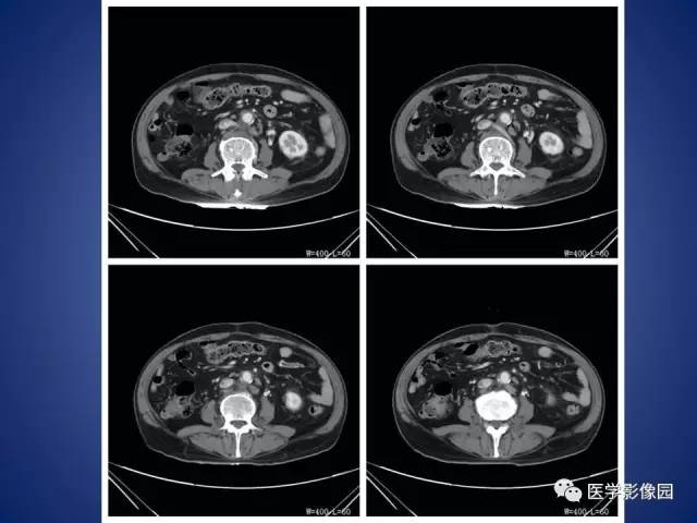 【病例】腹主动脉假性动脉瘤1例CT