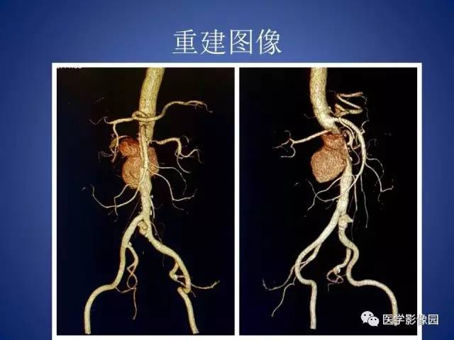 【病例】腹主动脉假性动脉瘤1例CT