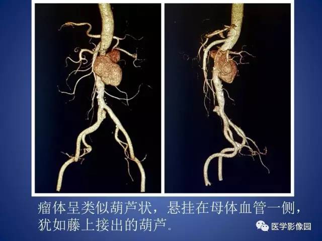 【病例】腹主动脉假性动脉瘤1例CT