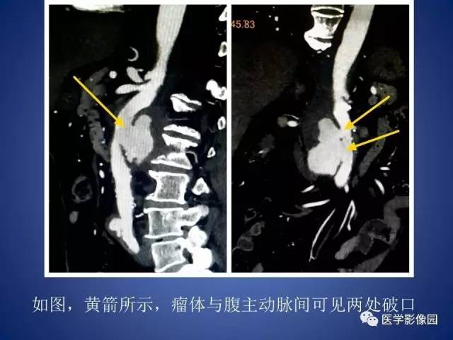 【病例】腹主动脉假性动脉瘤1例CT