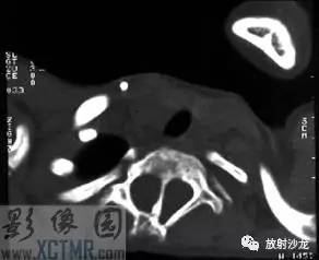 【病例】脊髓纵裂畸形1例CT及MR