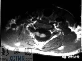 【病例】脊髓纵裂畸形1例CT及MR 【病例】脊髓纵裂畸形1例CT及MR