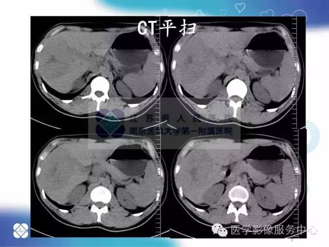 【病例】肝脏局灶性结节性增生1例CT及MR