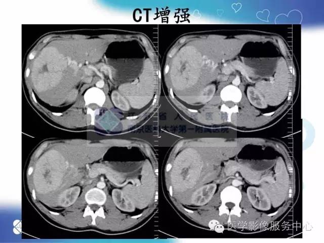 【病例】肝脏局灶性结节性增生1例CT及MR