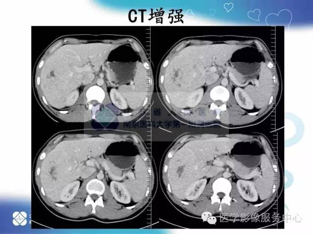 【病例】肝脏局灶性结节性增生1例CT及MR