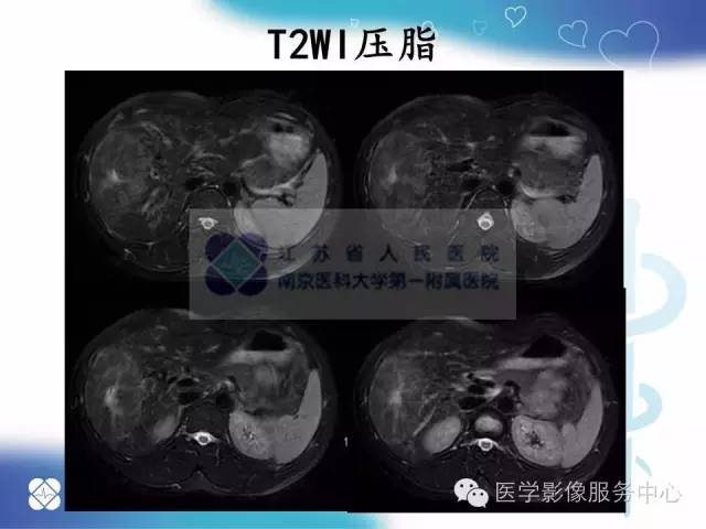 【病例】肝脏局灶性结节性增生1例CT及MR