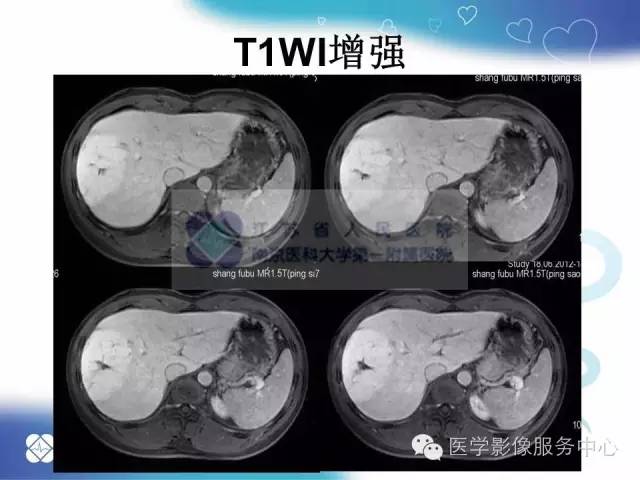 【病例】肝脏局灶性结节性增生1例CT及MR