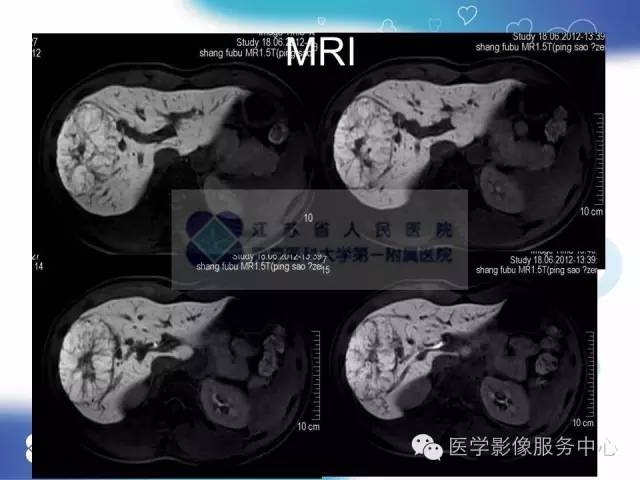 【病例】肝脏局灶性结节性增生1例CT及MR