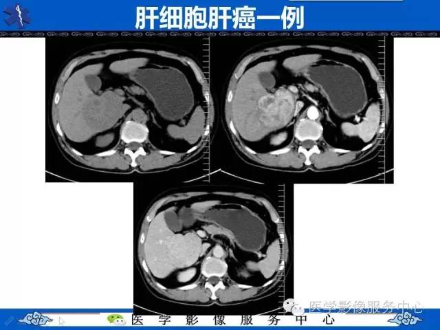 【病例】肝脏局灶性结节性增生1例CT及MR