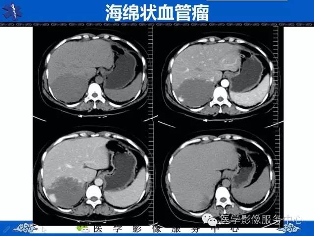 【病例】肝脏局灶性结节性增生1例CT及MR