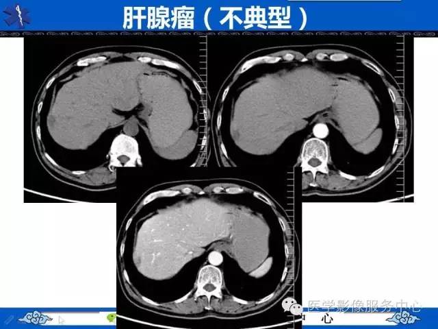 【病例】肝脏局灶性结节性增生1例CT及MR
