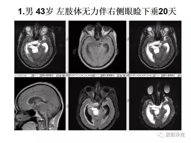 【PPT】垂体瘤的MR诊断与鉴别诊断