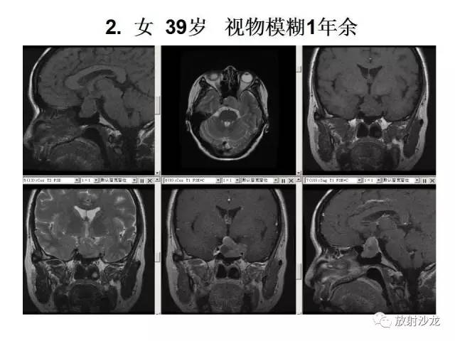【PPT】垂体瘤的MR诊断与鉴别诊断