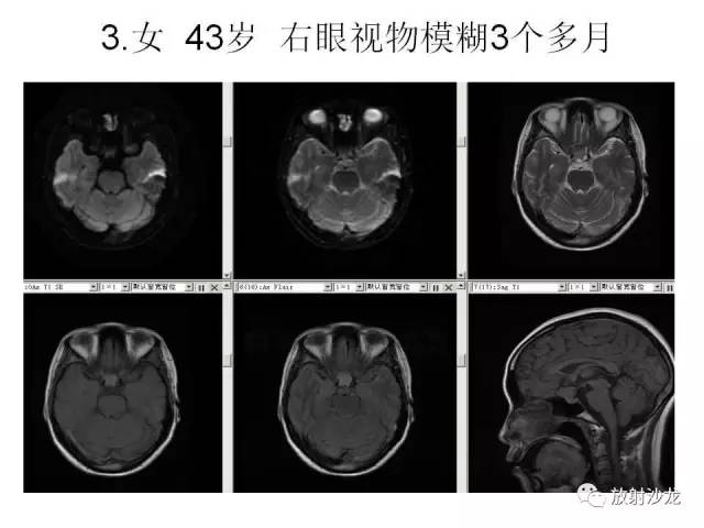 【PPT】垂体瘤的MR诊断与鉴别诊断