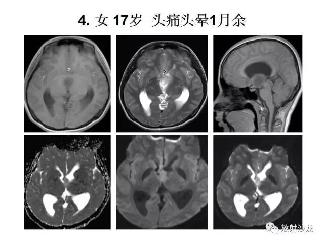 【PPT】垂体瘤的MR诊断与鉴别诊断