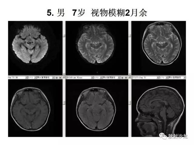 【PPT】垂体瘤的MR诊断与鉴别诊断