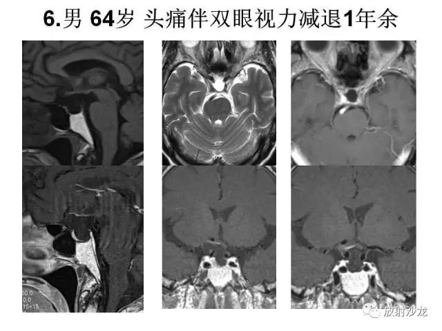 【PPT】垂体瘤的MR诊断与鉴别诊断