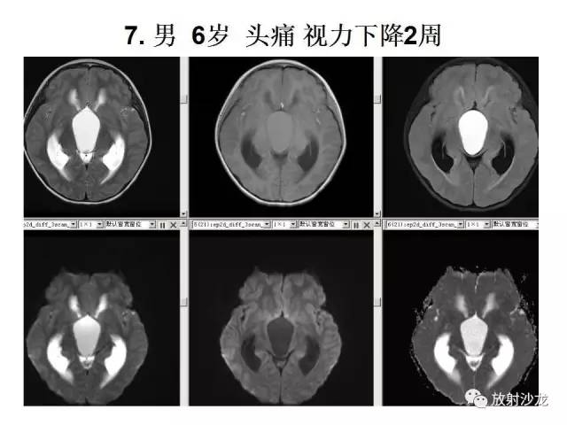 【PPT】垂体瘤的MR诊断与鉴别诊断