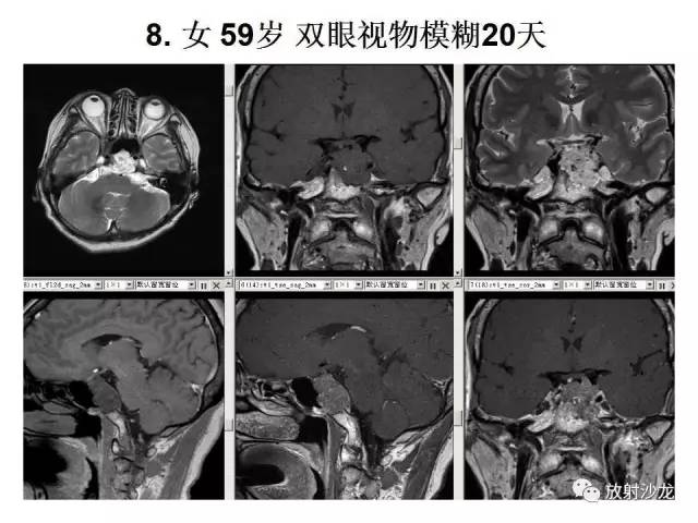 【PPT】垂体瘤的MR诊断与鉴别诊断