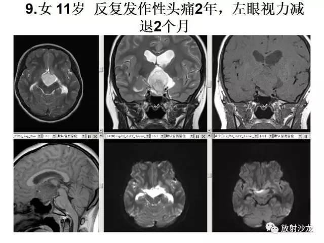 【PPT】垂体瘤的MR诊断与鉴别诊断