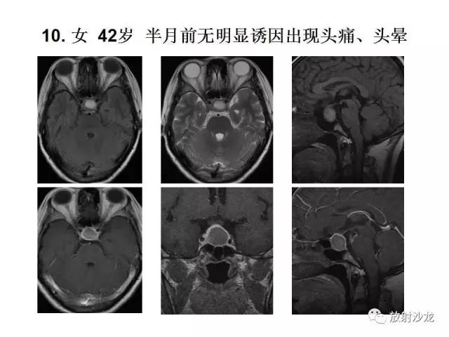 【PPT】垂体瘤的MR诊断与鉴别诊断