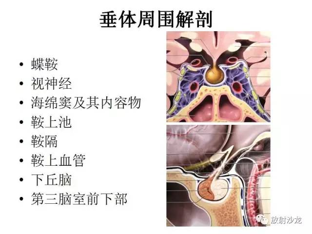 【PPT】垂体瘤的MR诊断与鉴别诊断