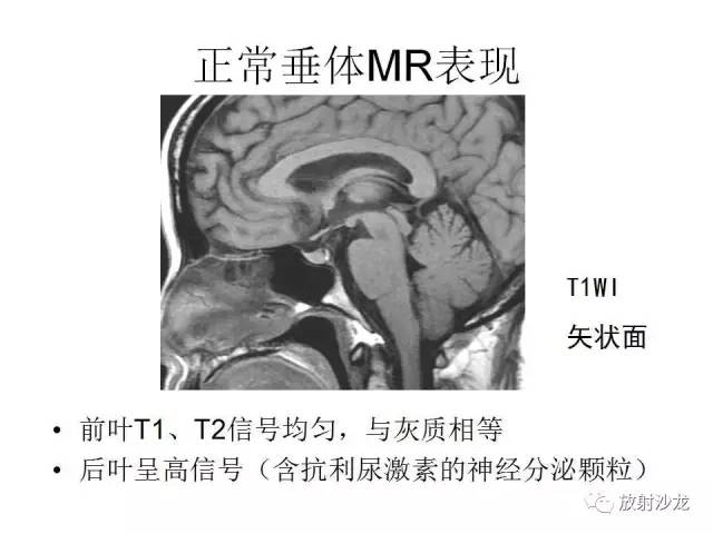 【PPT】垂体瘤的MR诊断与鉴别诊断