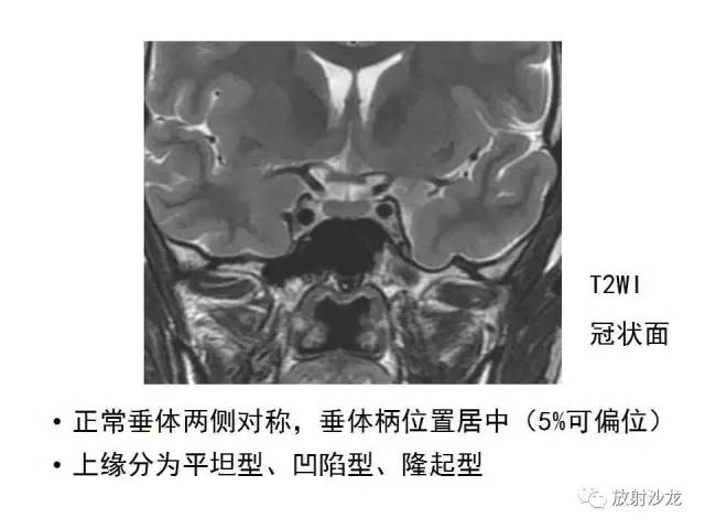 【PPT】垂体瘤的MR诊断与鉴别诊断