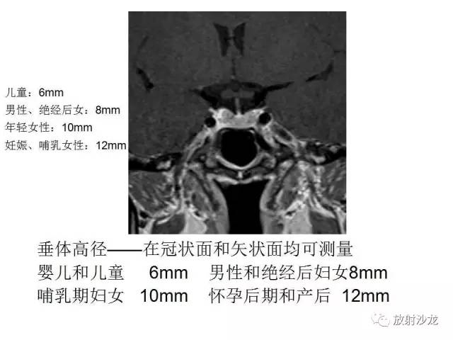 【PPT】垂体瘤的MR诊断与鉴别诊断