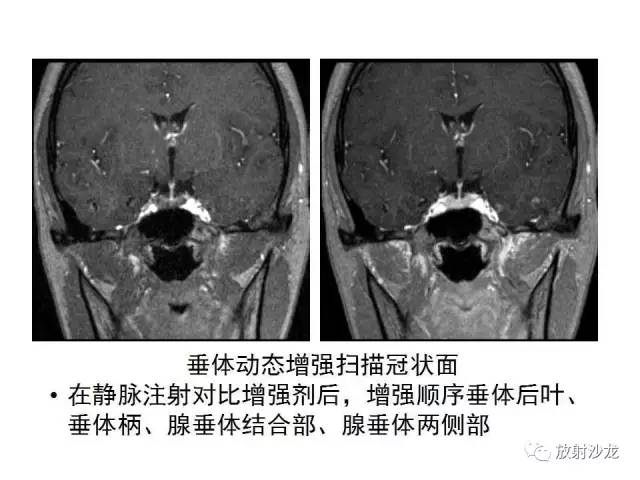 【PPT】垂体瘤的MR诊断与鉴别诊断
