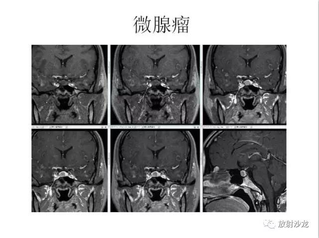 【PPT】垂体瘤的MR诊断与鉴别诊断
