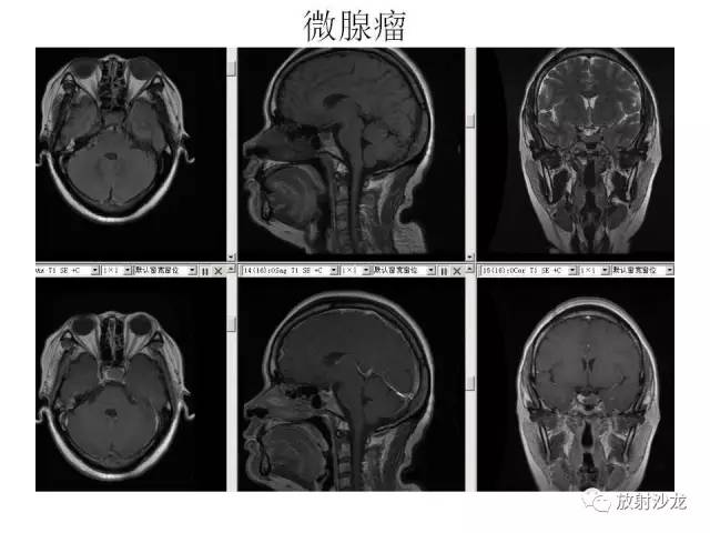 【PPT】垂体瘤的MR诊断与鉴别诊断