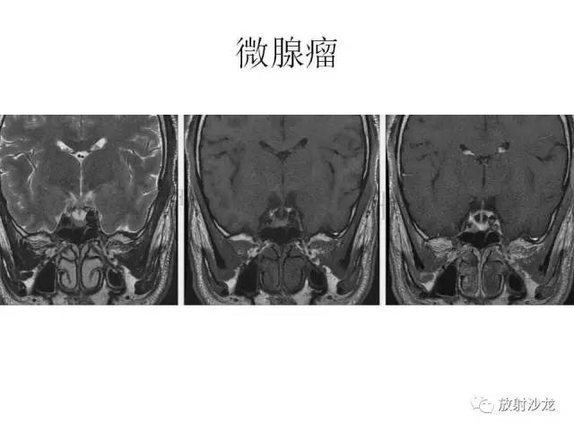 【PPT】垂体瘤的MR诊断与鉴别诊断