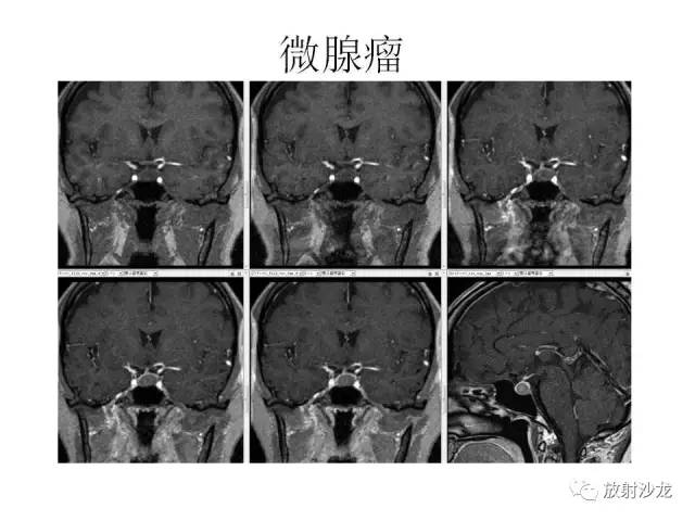 【PPT】垂体瘤的MR诊断与鉴别诊断