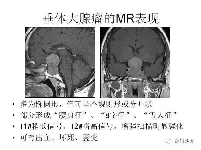 【PPT】垂体瘤的MR诊断与鉴别诊断